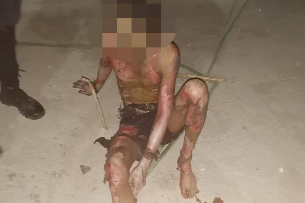 murió hombre severas quemaduras