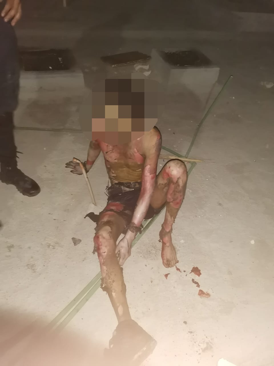 hombre rescatado severas quemaduras