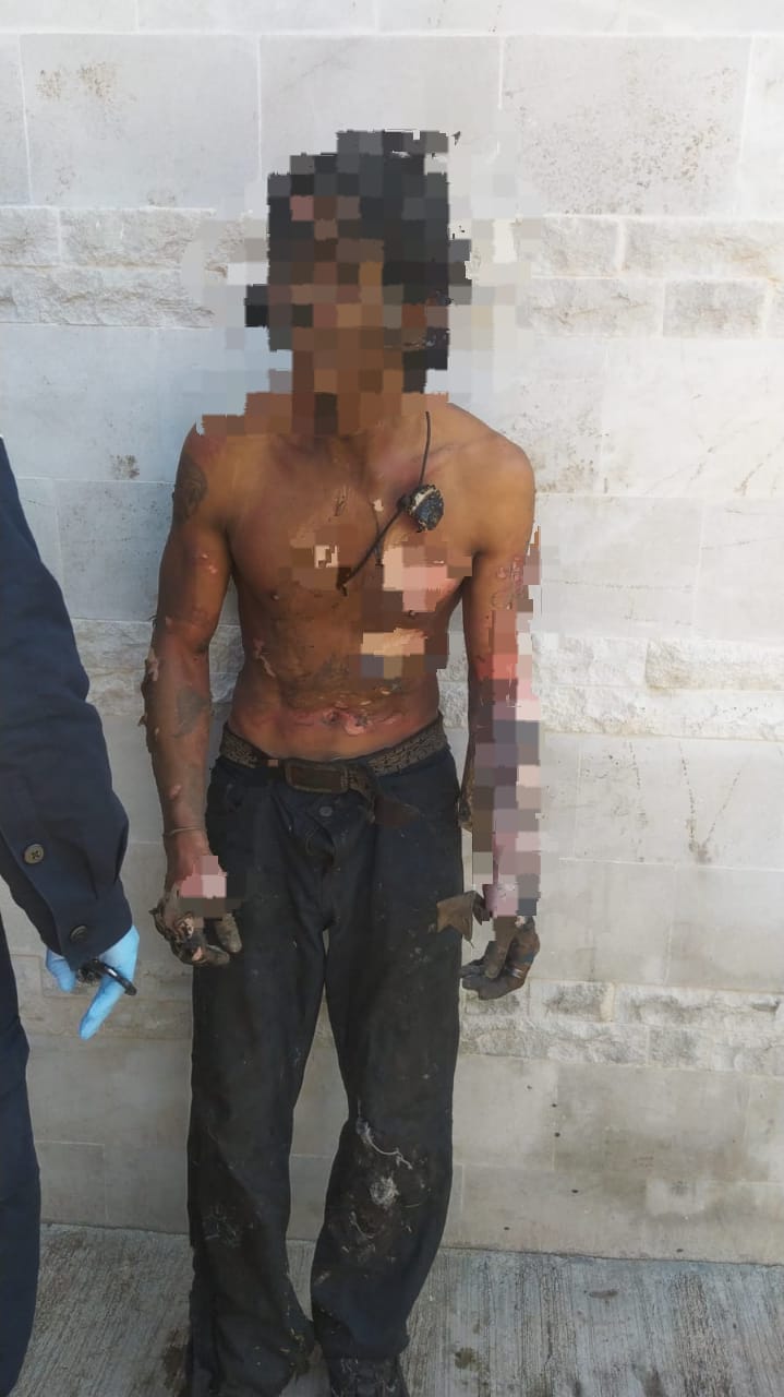 INDIGENTE RESULTA GRAVEMENTE HERIDO TRAS SUFRIR QUEMADURAS EN DISTINTAS PARTES DEL CUERPO