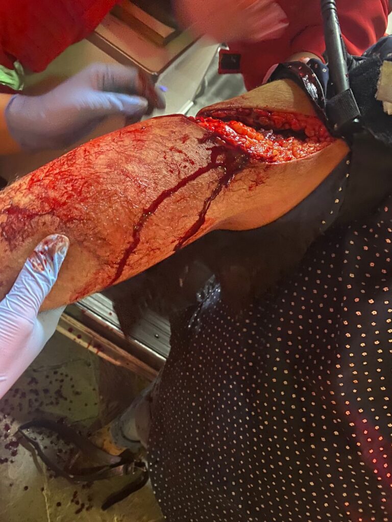 Casi pierde el brazo tras ser atacado con machete en la Feria de San Marcos